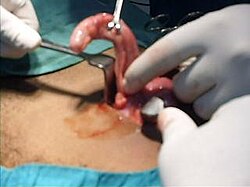 Cirugía abierta de apéndice