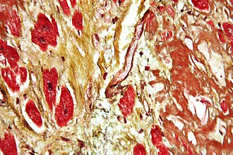Micrografía de un corazón con fibrosis y material amiloide.