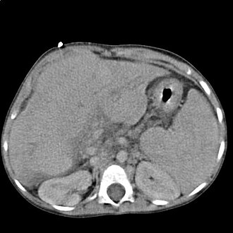 Representación axial de un hígado afectado por cirrosis en una tomografía computada de abdomen