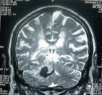 Resonancia magnética de cráneo que muestra hemorragia intracerebral profunda en el cerebelo