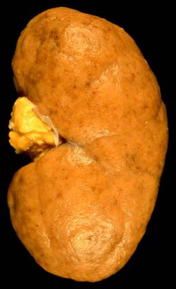 Nefritis lúpica proliferativa difusa