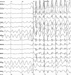 Representación de una punta-onda lenta epiléptica en un registro de EEG.