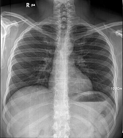 Radiografía médica de un pulmón humano