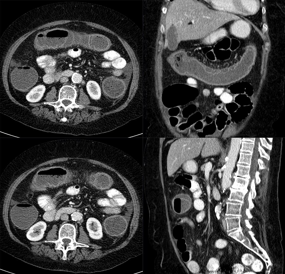 Vista de tomografía axial computada que muestra el colon en corte horizontal.