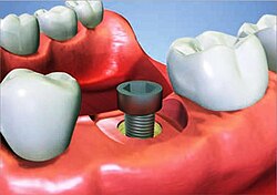 Representación visual de un implante dental osteointegrado en el maxilar
