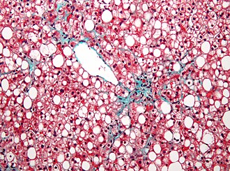 Micrografía de esteatosis hepática no alcohólica