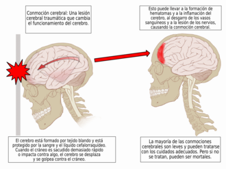 Representación de conmoción cerebral