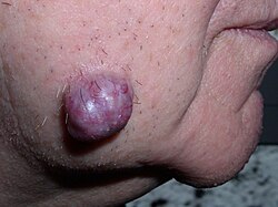 Fotografía clínica de un hidradenoma, neoplasia benigna de las glándulas sudoríparas en la piel.