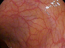Imagen de colonoscopia mostrando la flexura esplénica y mucosa normal.