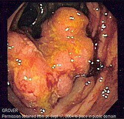 Imagen endoscópica que muestra una lesión compatible con cáncer colorrectal.