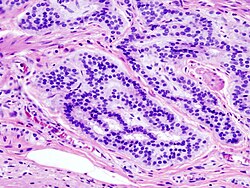 Imagen histopatológica de carcinoide de colon