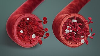 Representación comparativa entre niveles bajos y normales de azúcar en sangre