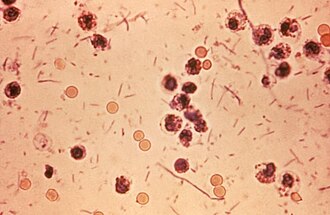 Fotomicrografía de una deposición con disentería por Shigella