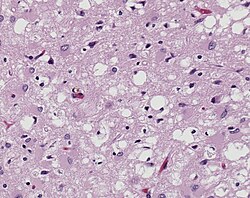 Tejido cerebral con cambios espongióticos por priones