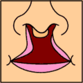 Representación gráfica de una fisura labial bilateral completa