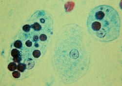 Trofozoítos de Entamoeba histolytica con eritrocitos ingeridos