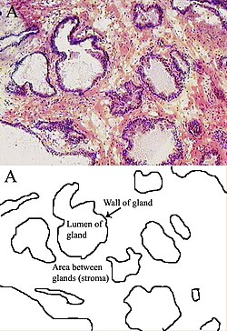 Microfotografía que muestra la histología del tejido epitelial y estromal de la próstata.
