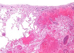 Micrografía de tejido pulmonar infartado junto a tejido relativamente normal
