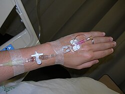 Paciente en un entorno clínico recibiendo fluidos mediante una vía intravenosa para corregir la deshidratación.
