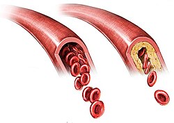 Arterioesclerosis