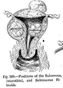 Representación gráfica que ilustra la presencia de fibromas uterinos como ejemplo de neoplasia benigna.