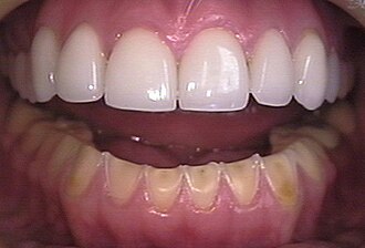Erosión en los dientes inferiores causada por bulimia