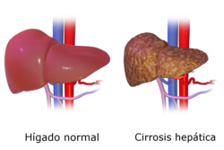 Comparación entre un hígado sano y uno con cirrosis