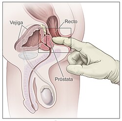 Esquema explicativo de la exploración médica mediante tacto rectal.