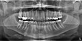 Braquiodoncia