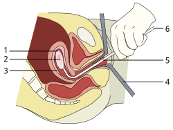Aborto por aspiración a las ocho semanas de gestación